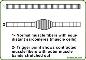 Pelvic Floor Myofascial Trigger Points: Manual Therapy for Interstitial Cystitis and Urgency-Frequency Syndrome